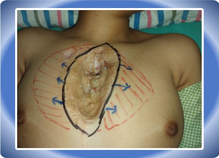 STERNAL DEFECT